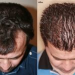 Temple Hair Loss and Temple Hair Transplant Surgery