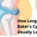 How Long Do Baker’s Cysts Usually Last? Comprehensive Overview