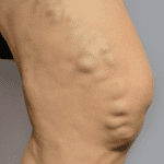 Pelvic varicose veins in Jacksonville