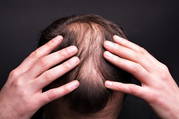 Best Hair Transplant in Jaipur