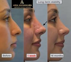 best rhinoplasty surgeons in Pakistan