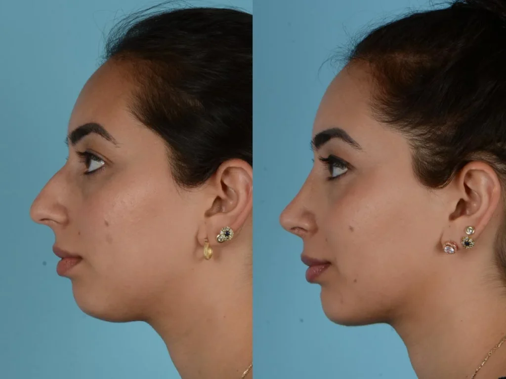 Best rhinoplasty surgeon in Lahore