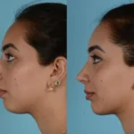 Best rhinoplasty surgeon in Lahore