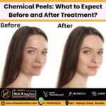 chemical peels treatment before and after