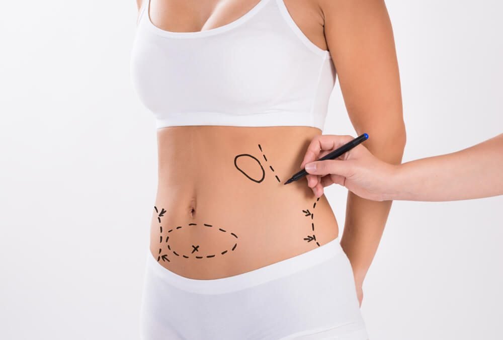 Liposuction Surgery in Dubai