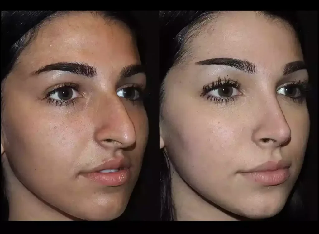 Rhinoplasty in Dubai: Achieve the Perfect Nose with Expert Surgeons