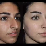 Rhinoplasty in Dubai: Achieve the Perfect Nose with Expert Surgeons