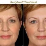 Restylane Injections