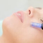 microneedling naples fl