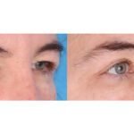 Why Does Eyelid Sagging Occur, and Can Surgery Fix It?