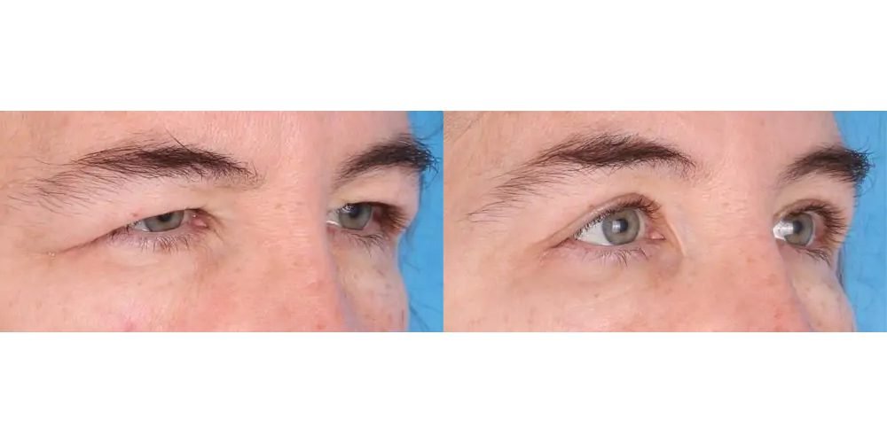 Why Does Eyelid Sagging Occur, and Can Surgery Fix It?