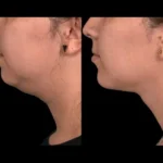 Double chin removal