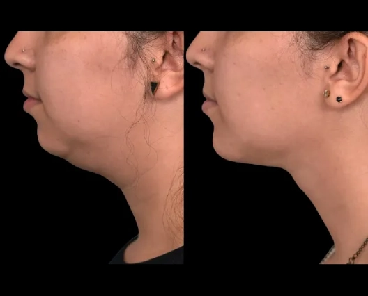 Double chin removal