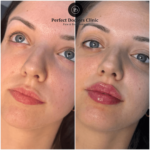 Dermal Fillers