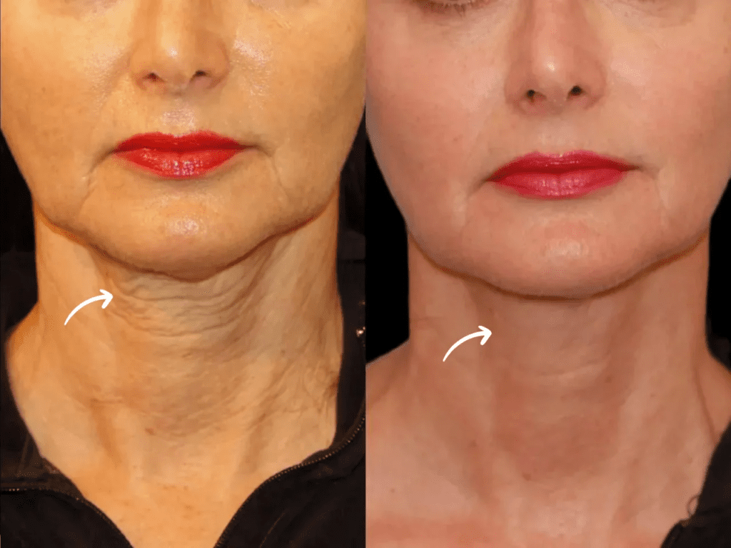 Sculptra Fillers