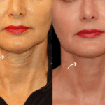 Sculptra Fillers