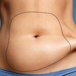 Liposuction in Dubai