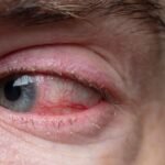 Heal Pink Eye Fast