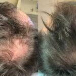 exosomes for hair loss