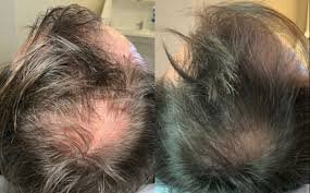 exosomes for hair loss