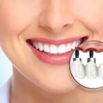 Invisalign Treatment in Chennai