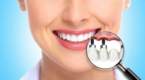 Invisalign Treatment in Chennai