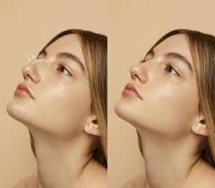 Best Ultrasonic Rhinoplasty in Dubai: A Revolutionary Approach to Nose Reshaping