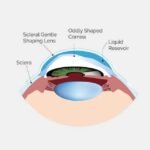 The Pros and Cons of Scleral Lenses Compared to Regular Contact Lenses