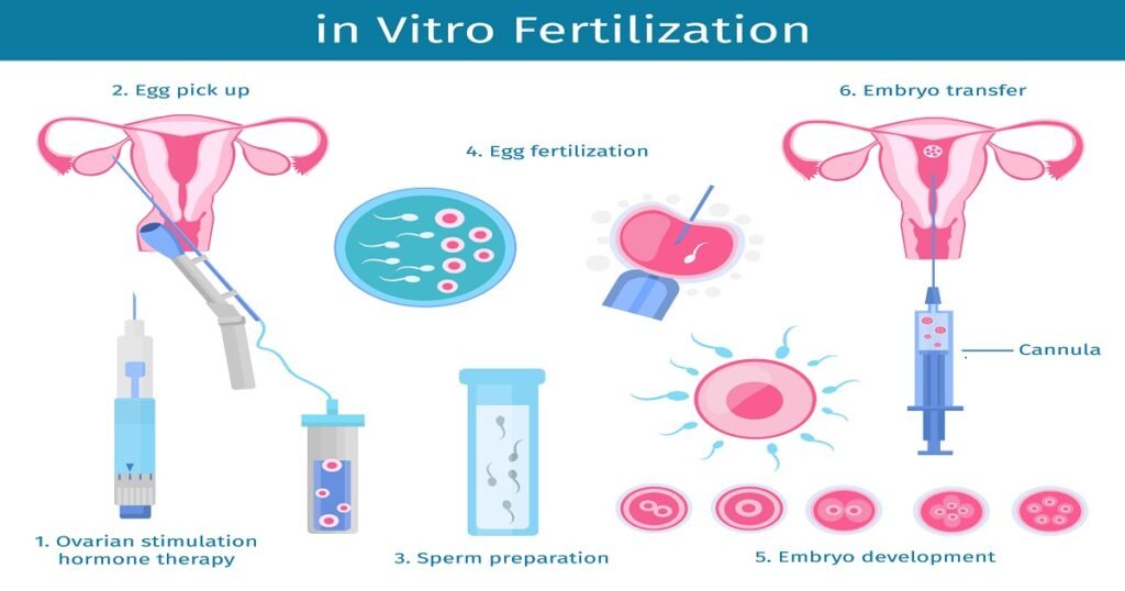 ivf