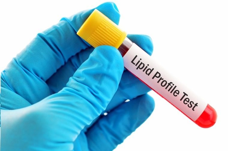 Lipid Profile Test