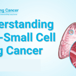 What Is Non-Small Cell Lung Cancer (NSCLC) and Its Causes